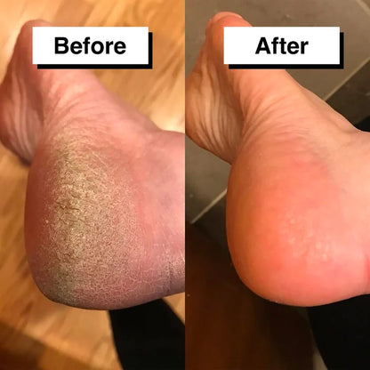 Pedicuure - Automatic Callus Remover